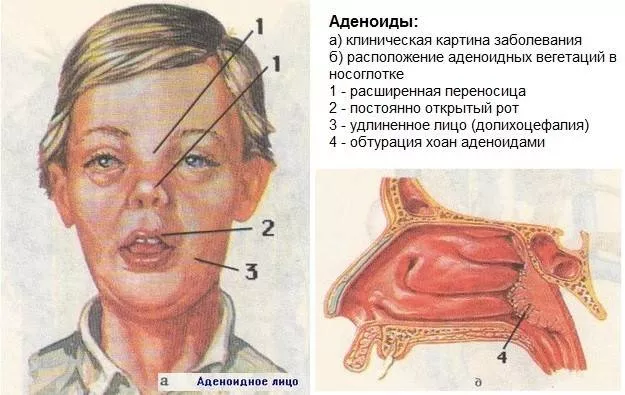 Время проверить своего ребенка на Аденоиды